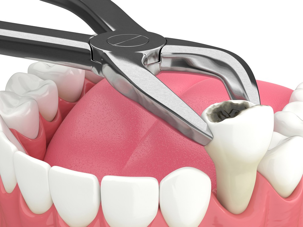 chirurgie dentara bucuresti, drm bucuresti, extractie dentara bucuresti, stomatologie bucuresti