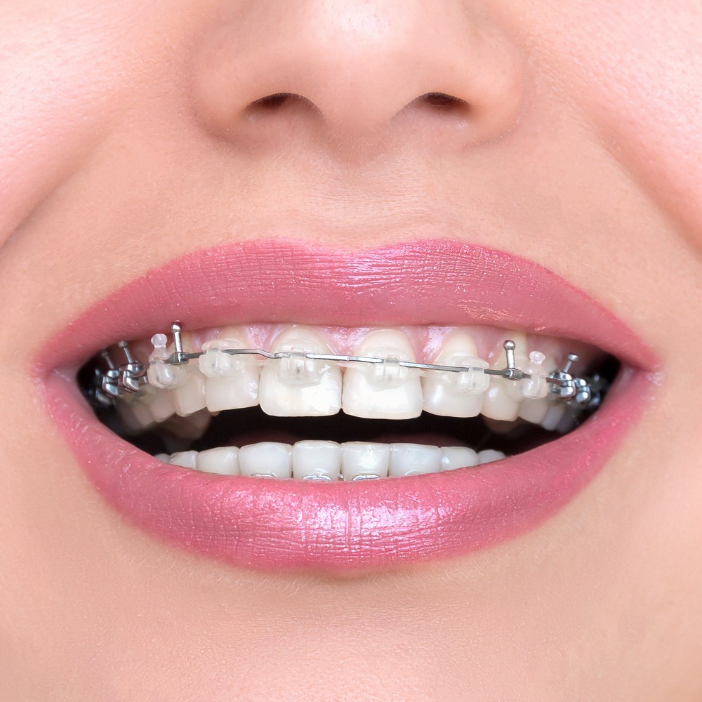 stomatologie bucuresti, ortodontie bucuresti, aparat dentar bucuresti, aparat metalic bucuresti