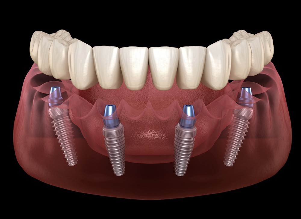 implant dentar bucuresti, stomatologie bucuresti, clinica drm bucuresti